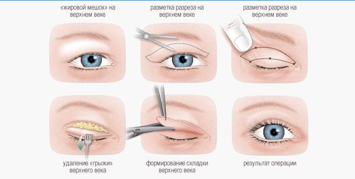 Blepharoplastika v schéme