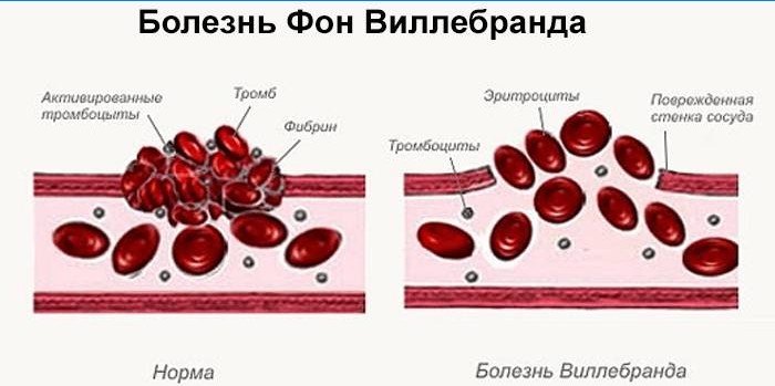 Von Willebrandova choroba