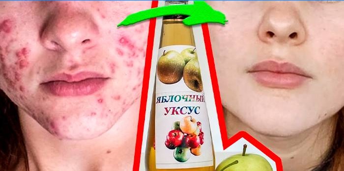 Jablčný ocot Acne