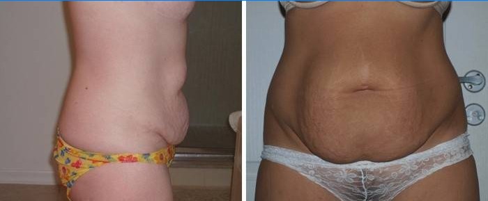 Indikácie abdominoplastiky brucha: záhyby a tuková zástera