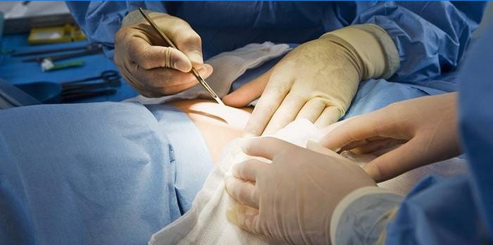 Klasická abdominoplastika brucha