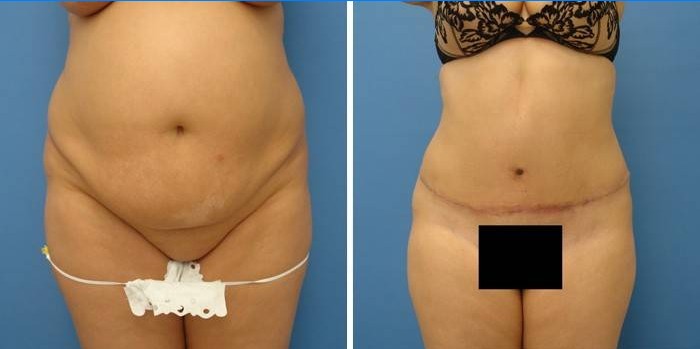Fotografie pred a po abdominoplastike brucha