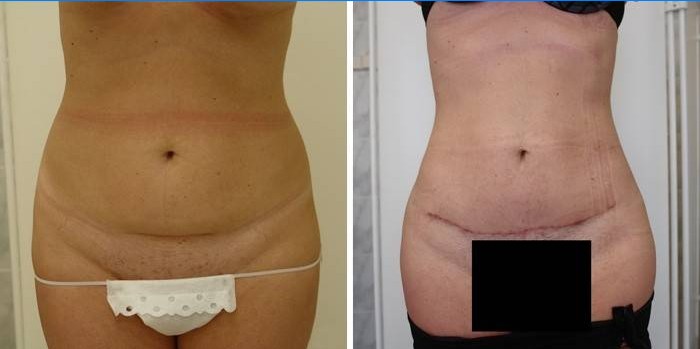 Brucho po abdominoplastike