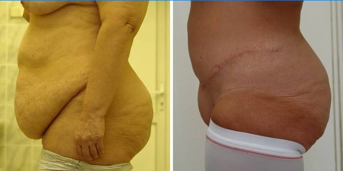 Výsledok abdominoplastiky