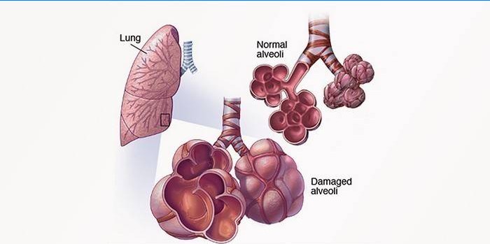 Exogénna alergická alveolitída