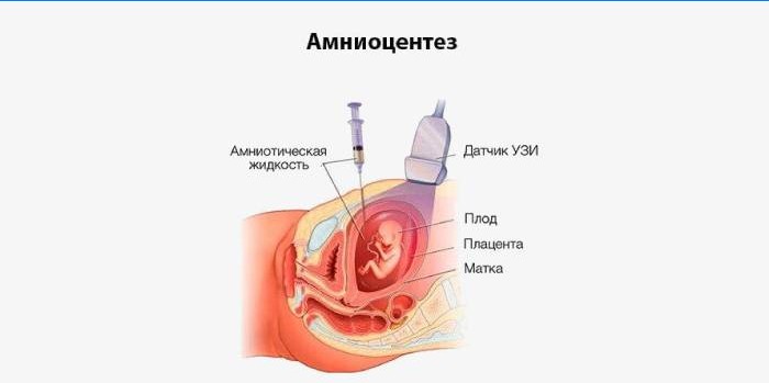 Amniocentéza o schéme