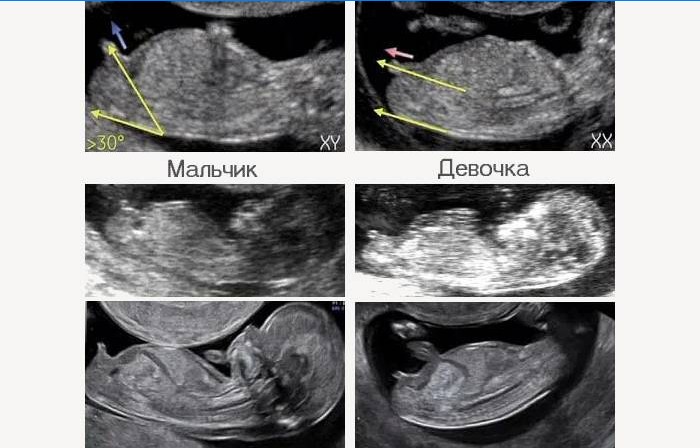 Ultrazvukové obrázky chlapca a dievčaťa