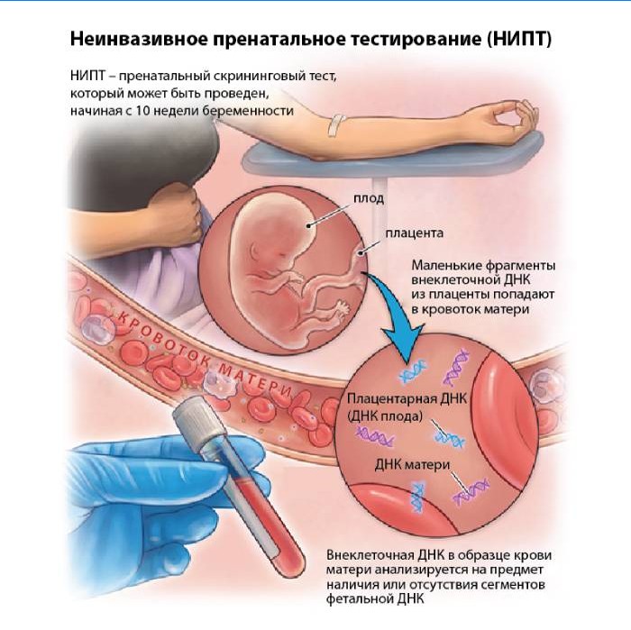 Neinvazívne prenatálne testovanie (NIPT)