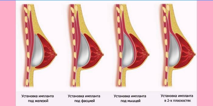 Metódy inštalácie prsných implantátov